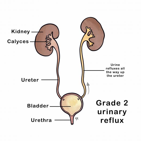 Grade 2 urinary reflux with genitourinary anatomy