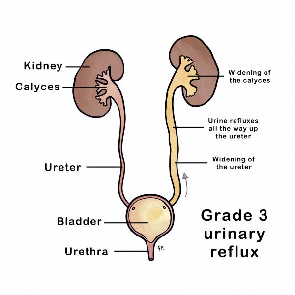 Grade 3 urinary reflux with genitourinary anatomy