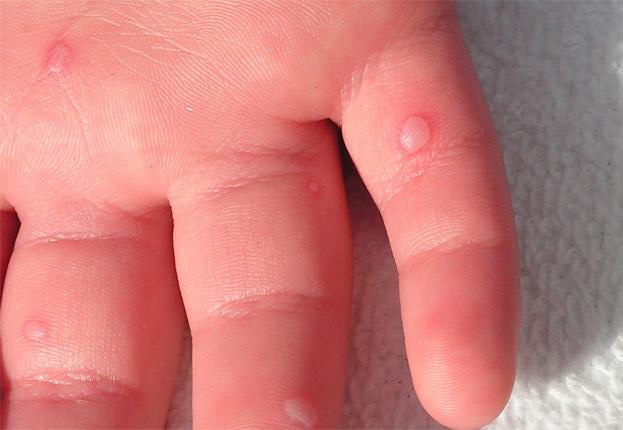 Hand blisters on a child with hand, foot and mouth disease