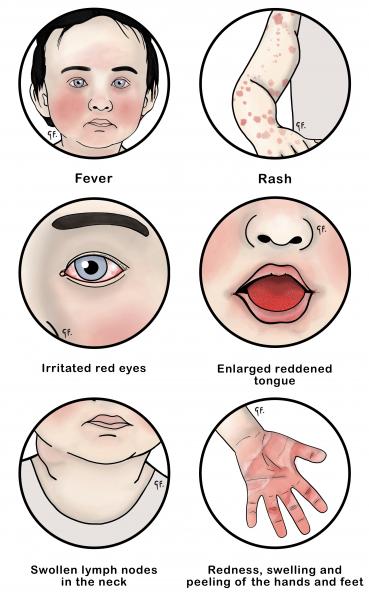 Image showing some of the symptoms of kawasaki disease in children