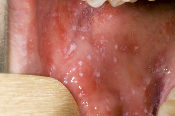 White spots inside the mouth (Koplik spots)