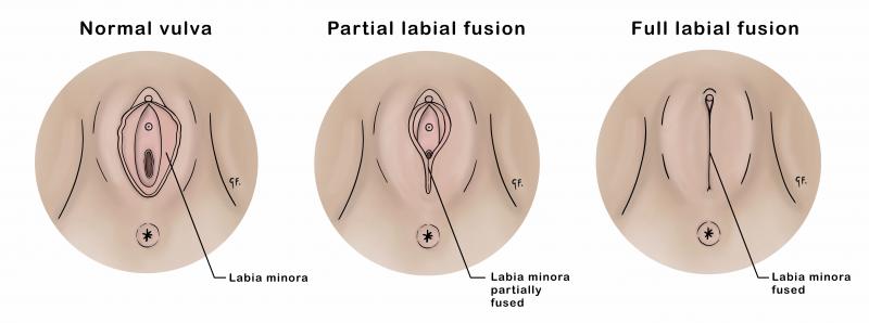Medical illustration showing partial and full labial fusion alongside a normal vulva