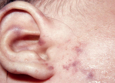Meningococcal Disease Kidshealth Nz