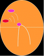Diagram showing atrial tachycardia
