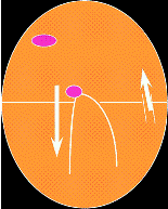 Diagram showing atrio-ventricular re-entrant tachycardia