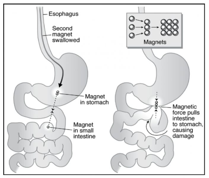 Image showing swallowed magnets and how the affect the intestines 
