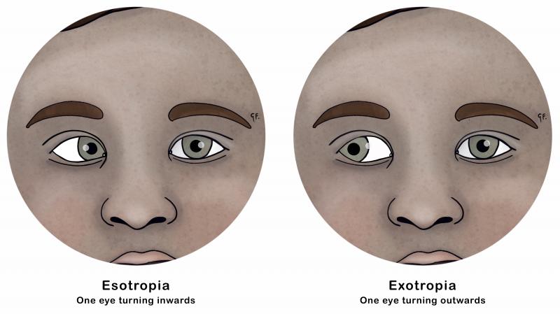 Illustration show esotropia and exotropia 