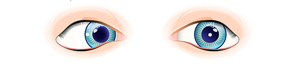 Picture of 2 eyes - one eye turning inwards