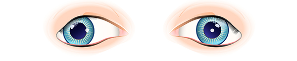 Picture of 2 eyes - one eye turning outwards