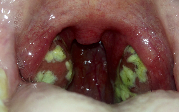 Photo showing tonsillitis