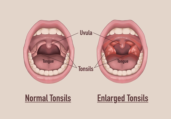Picture of normal and enlarged tonsils