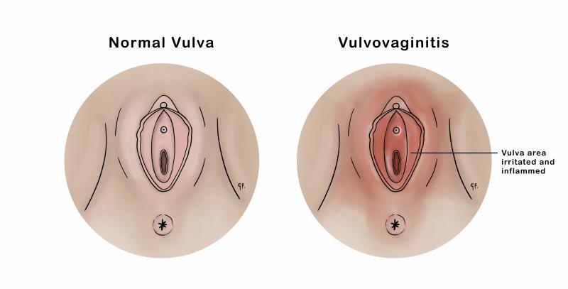 Medical illustration of normal vulva and vulvovaginitis 