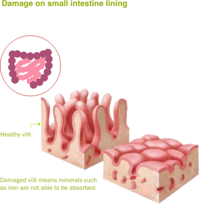 Diagram showing damage on small intestine lining