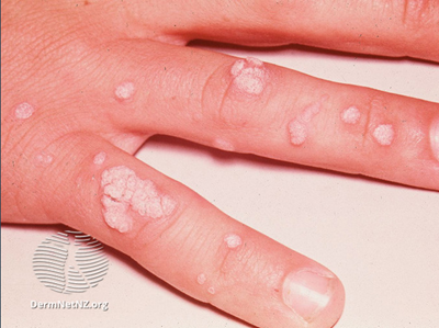 Warts on fingers