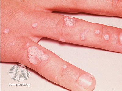 Warts treatment nz. Totul despre HPV: simptome şi tratament, Human papillomavirus treatment nz