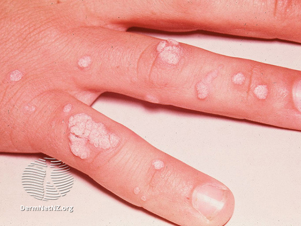 Warts on fingers