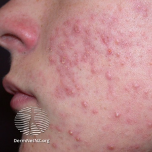A teenager with acne