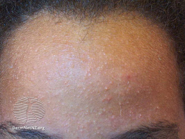 A teenager with acne on the forehead