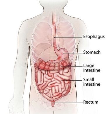 Diagram of a digestive system with Crohn's disease