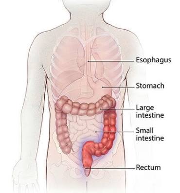 Diagram of a digestive system with ulcerative colitis