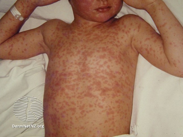 Photo of a boy's chest with the measles rash
