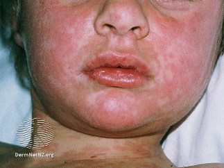 Photo of a boy's face with measles rash