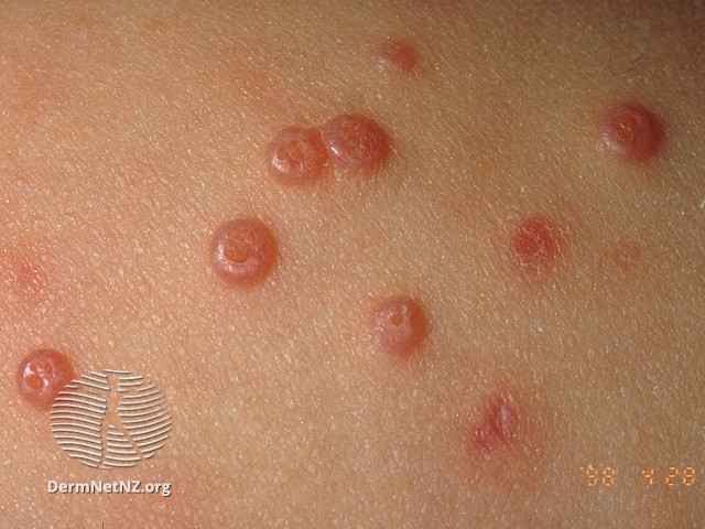 Photo showing molluscum contagiosum on the skin