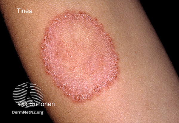 A child's arm with ringworm