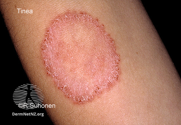 Urticaria Rash - Stock Image - C022/2141 - Science Photo Library