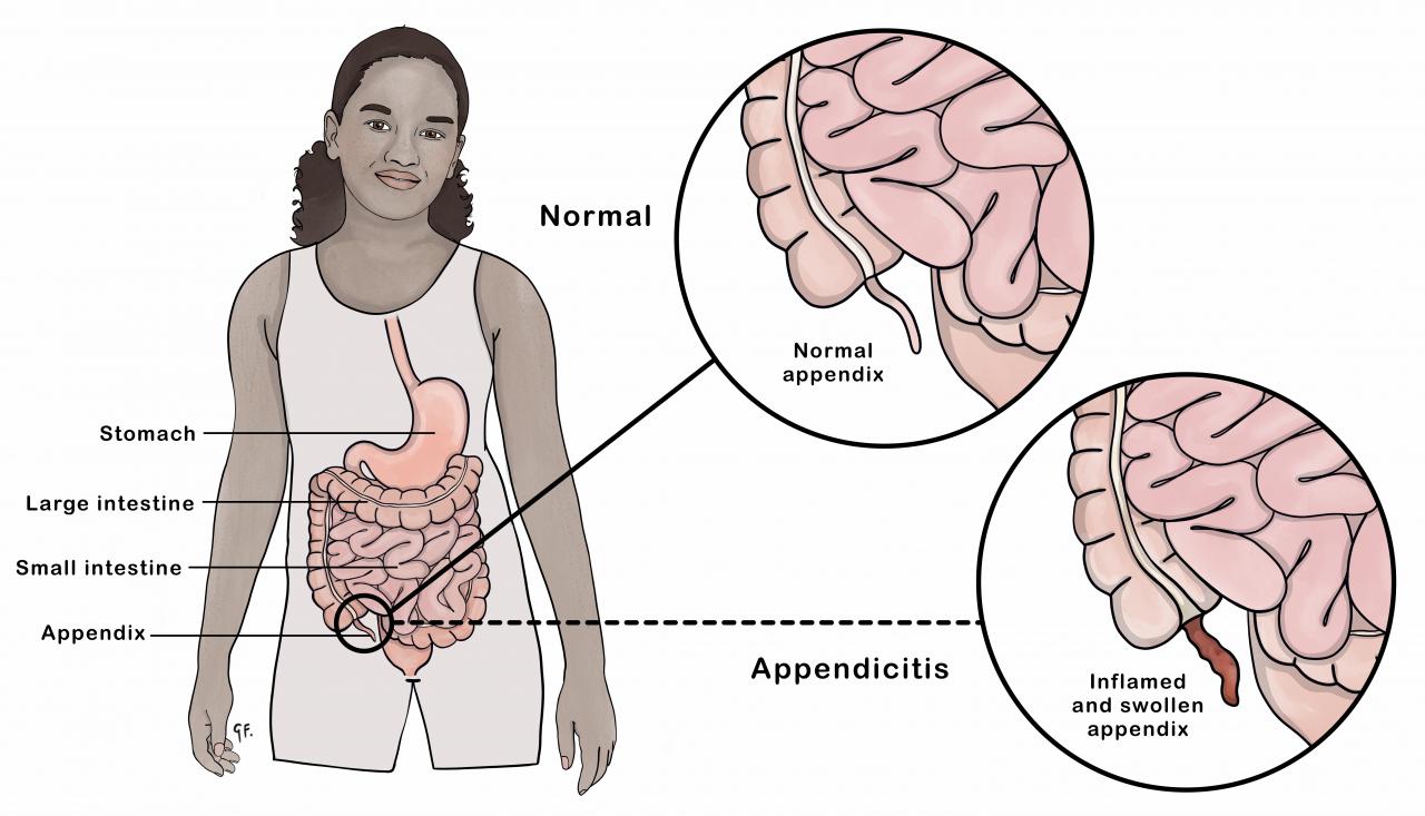 Image of a normal and inflammed appendix (appendicitis) 