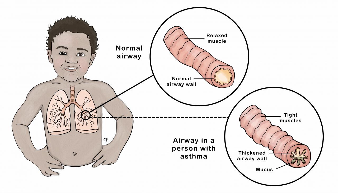 illustration of a child showing the airway changes that occur in asthma