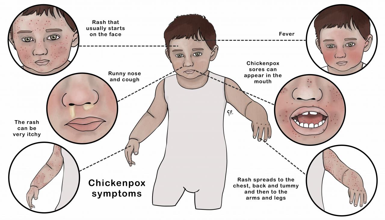 Chickenpox symptoms 