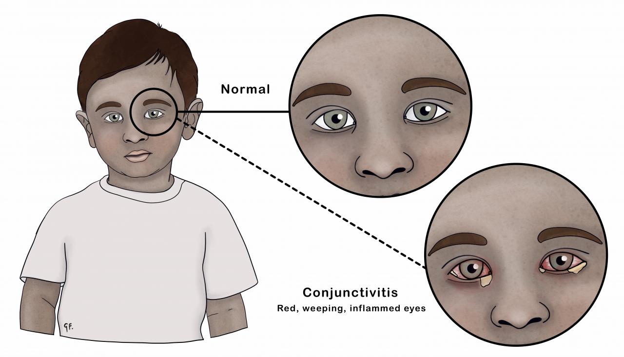 Illustration of a child with conjunctivitis compared with normal eyes