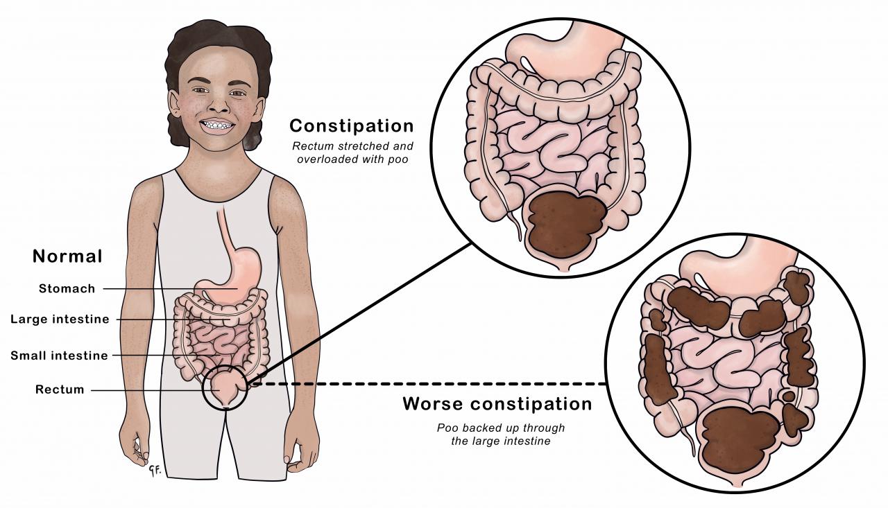 Illustration showing constipation in a young child 