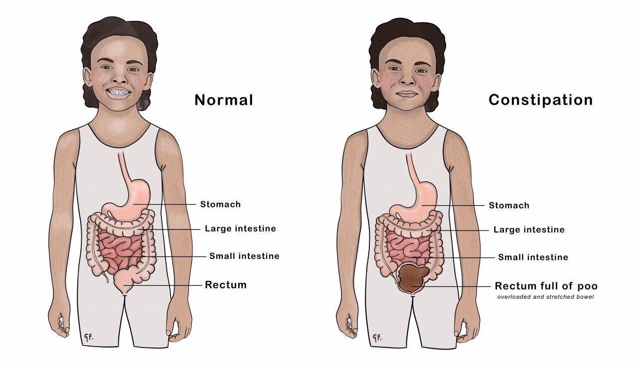 Illustration comparing constipation with normal bowel in a child