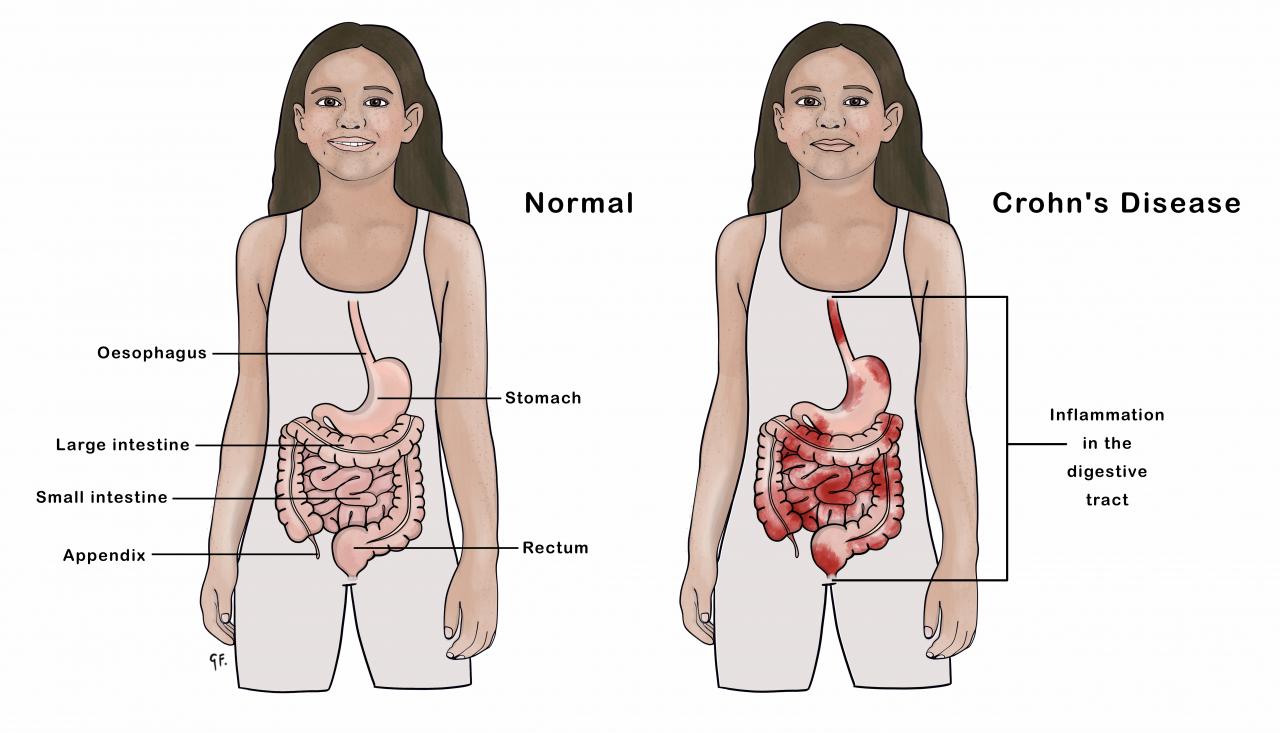 Illustration of child with normal gastrointestinal tract compared with Crohn's disease