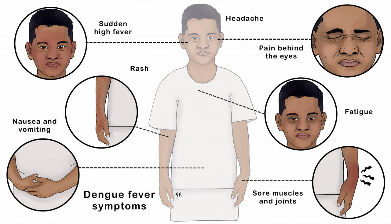 Illustration showing a child with symptoms of dengue fever