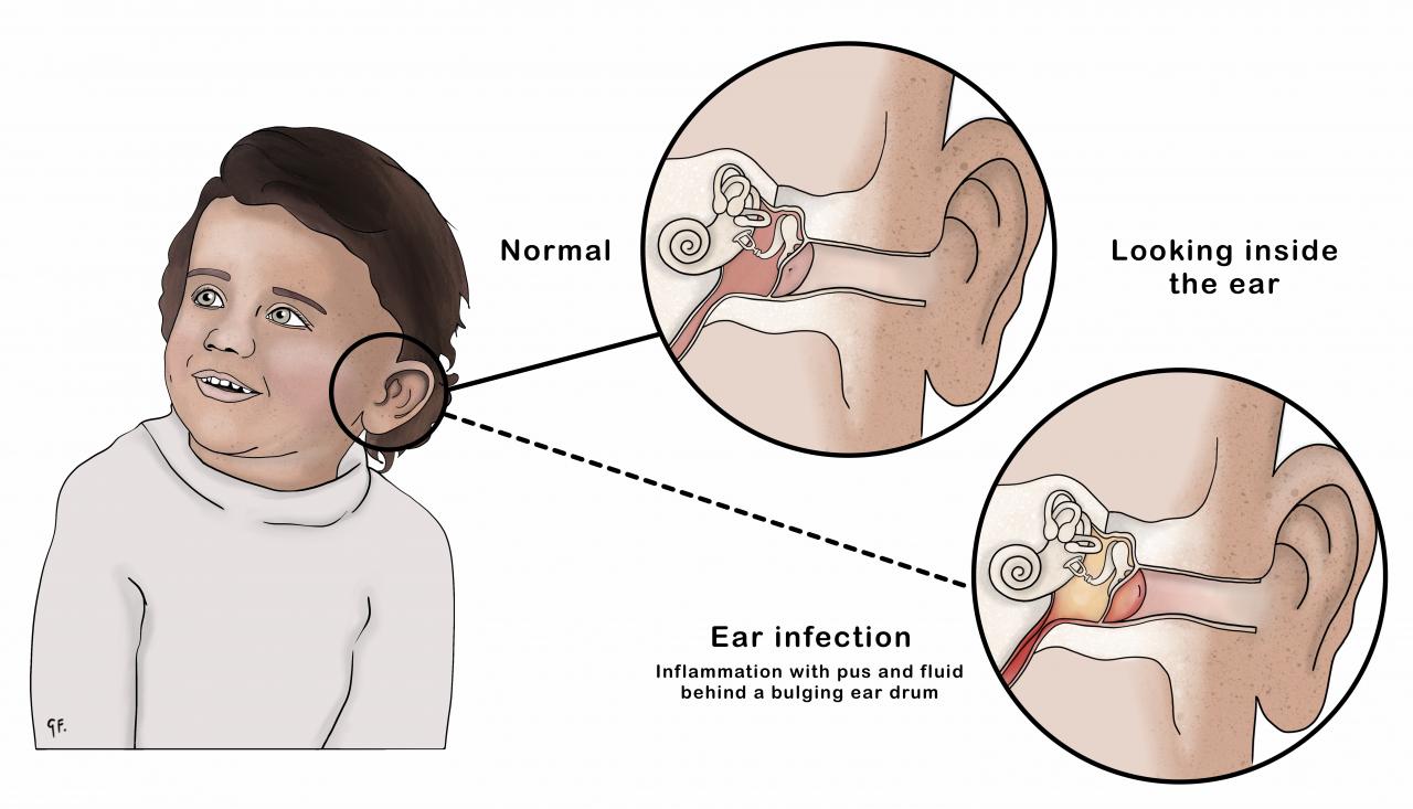 Illustrations showing inside of a normal ear compared with an ear infection