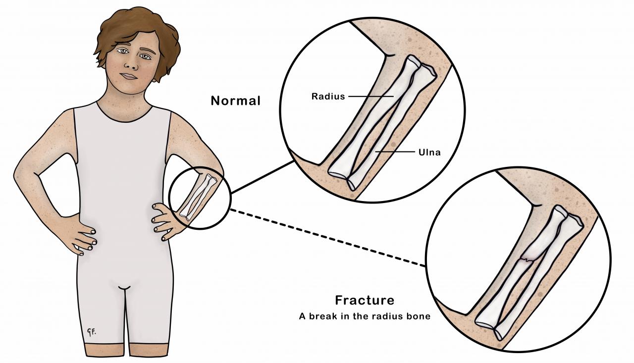 Illustration showing child with normal arm and fractured arm 