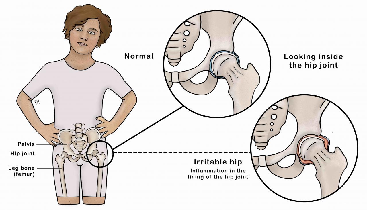 Illustration showing a normal hip joint and an inflamed hip joint from transient synovitis 