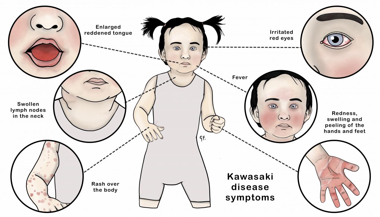 Illustration showing the symptoms of Kawasaki disease in a child 