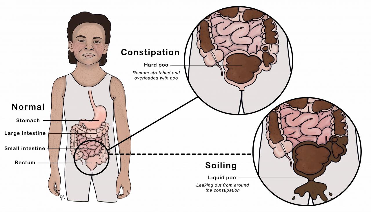 Illustration showing constipation with encopresis and soiling in a child
