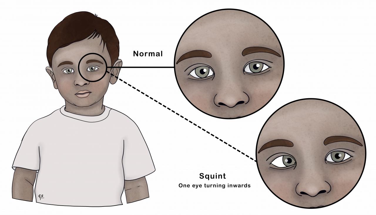 Illustration showing normal eyes compared with a squint in a child 