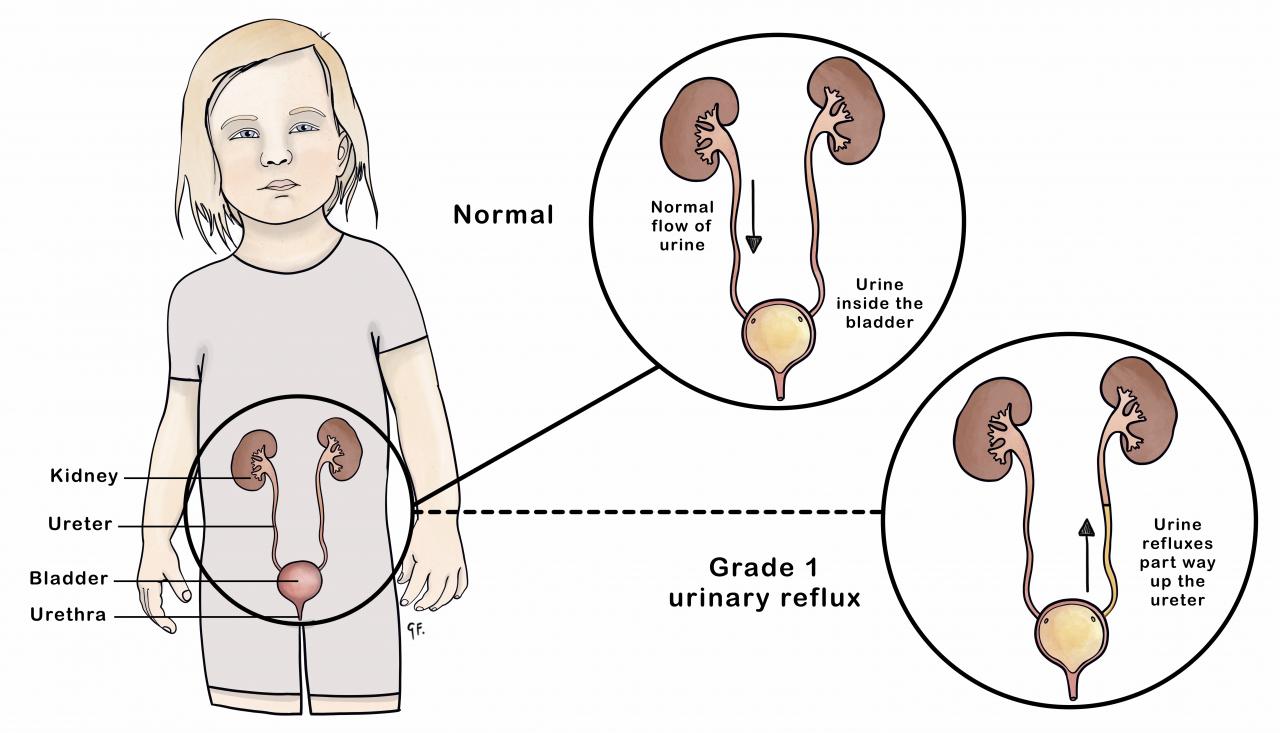 Image of a child showing urinary reflux and normal genitourinary anatomy