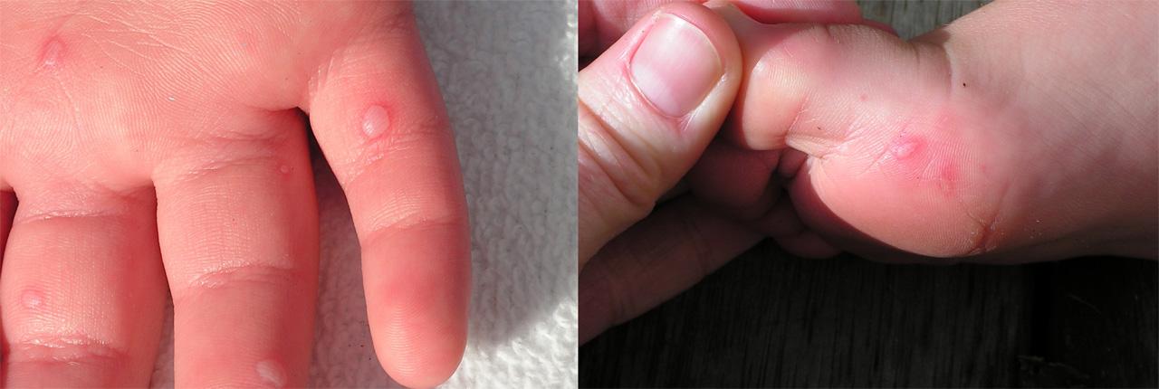Blisters on a childs hand and foot