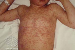 Child with measles rash on body