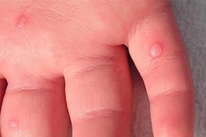 Blisters on the hand in a child with hand, foot and mouth disease