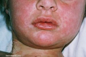 Boy with measles rash on face