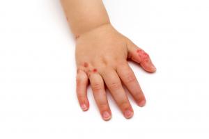 A child's hand showing a skin condition